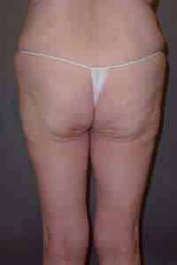Belt Lipectomy