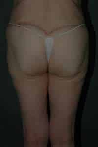 Belt Lipectomy