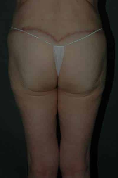 Belt Lipectomy