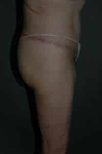 Belt Lipectomy