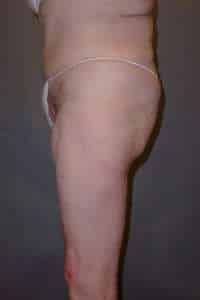 Belt Lipectomy