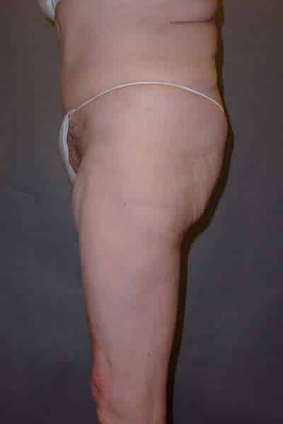 Belt Lipectomy