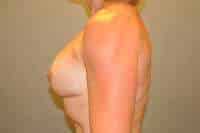 Breast Implant Exchange