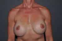 Breast Implant Exchange