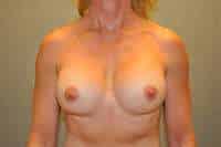 Breast Implant Exchange