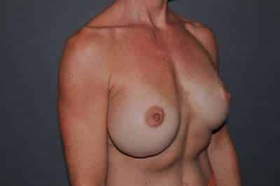 Breast Implant Exchange