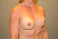 Breast Implant Exchange
