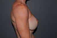 Breast Implant Exchange