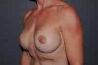 Breast Implant Exchange