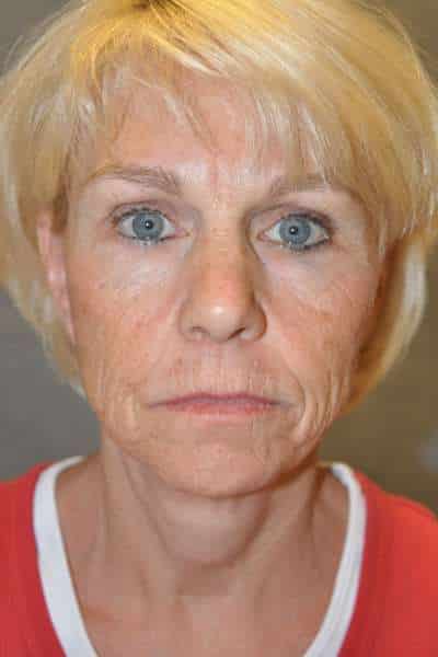 Facelift
