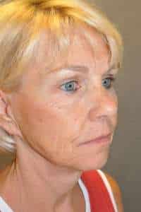 Facelift