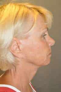 Facelift