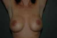 Breast Augmentation