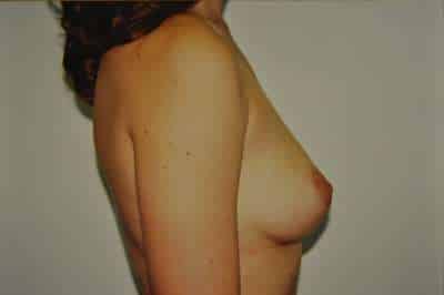 Breast Augmentation