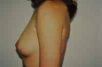 Breast Augmentation