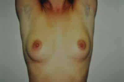 Breast Augmentation