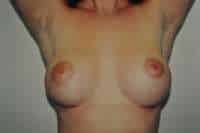 Breast Augmentation