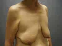 Breast Lift