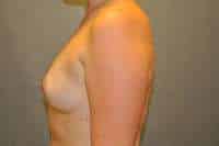 Breast Augmentation