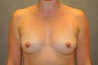 Breast Augmentation