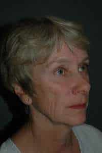 Eyelid Lift