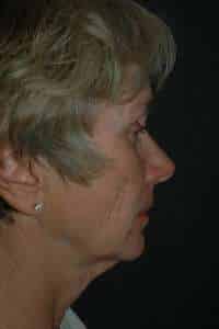 Eyelid Lift