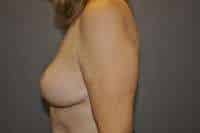 Breast Reduction