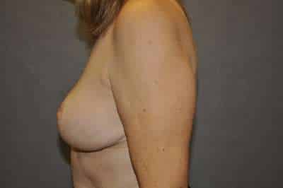 Breast Reduction