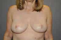 Breast Reduction