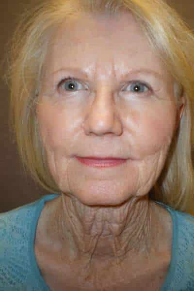 Facelift