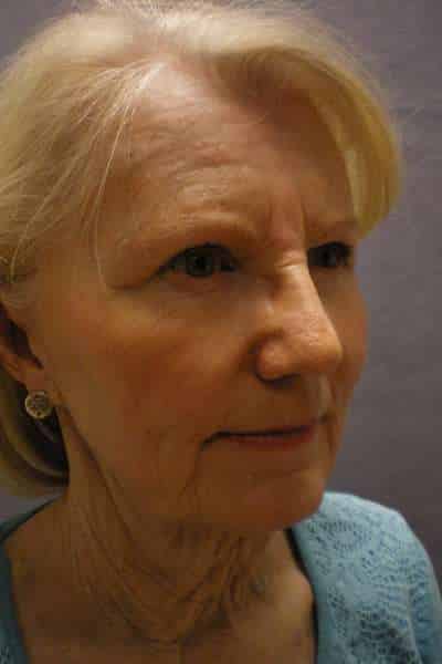 Facelift