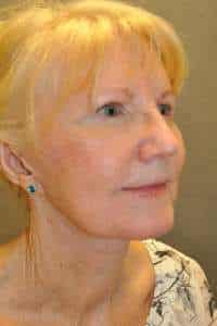 Facelift
