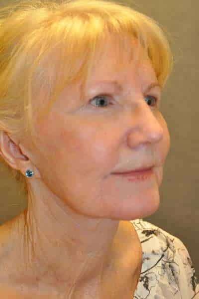 Facelift