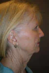 Facelift
