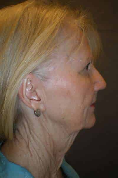 Facelift