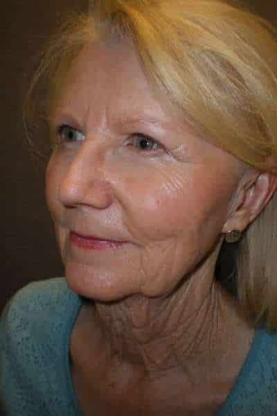 Facelift