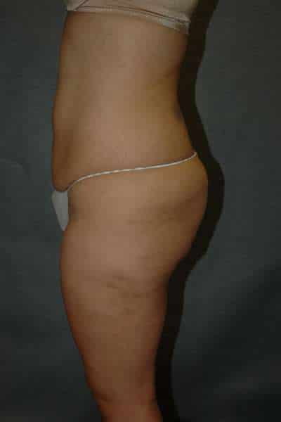 Belt Lipectomy