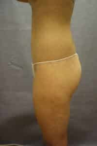 Belt Lipectomy