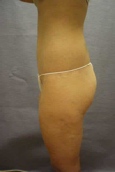 Belt Lipectomy