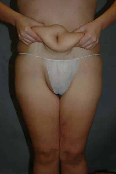 Belt Lipectomy
