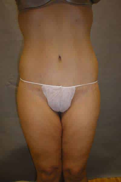 Belt Lipectomy