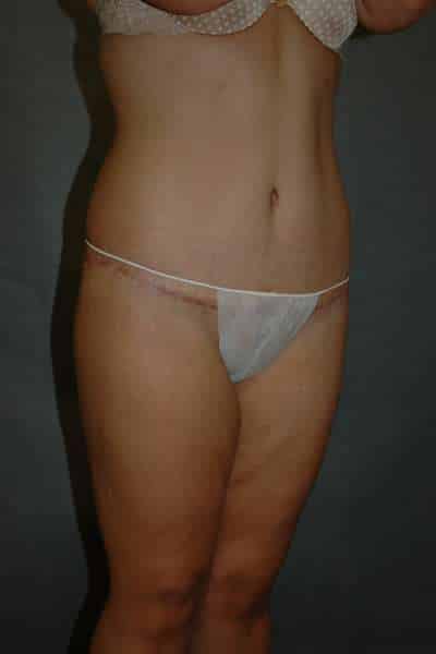 Belt Lipectomy
