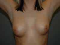 Breast Augmentation