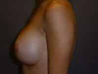 Breast Implant Exchange