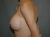 Breast Implant Exchange
