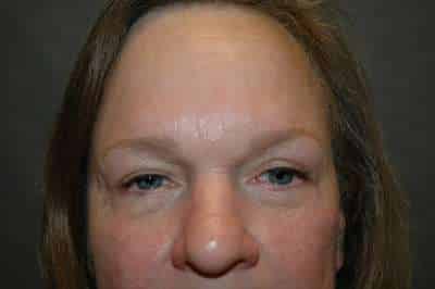 Eyelid Lift