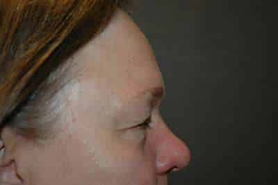 Eyelid Lift