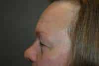 Eyelid Lift