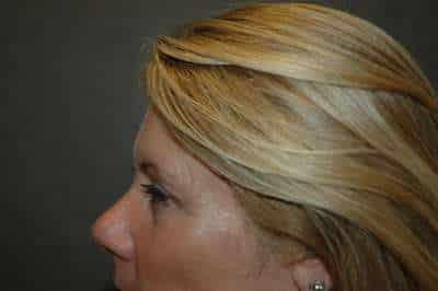 Eyelid Lift