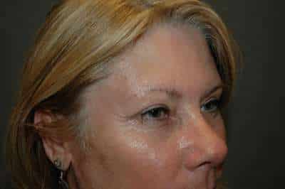 Eyelid Lift